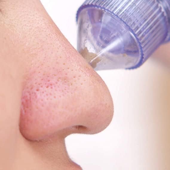 Blackhead Remover